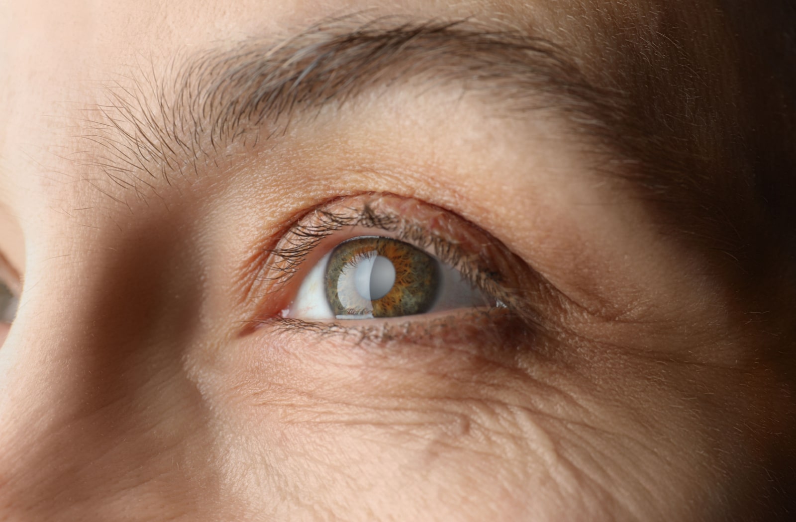 A close-up view of a woman with glaucoma