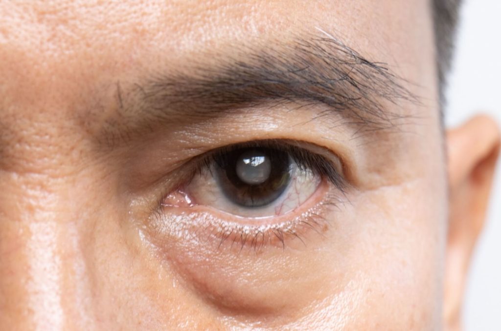 Close up of a man's eye with a cataract.