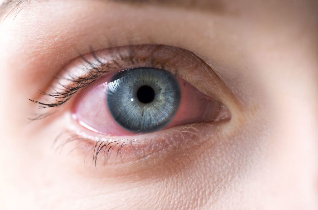 A person with bright blue eyes a pink eye looks into the camera with their red, swollen, and teary eye.