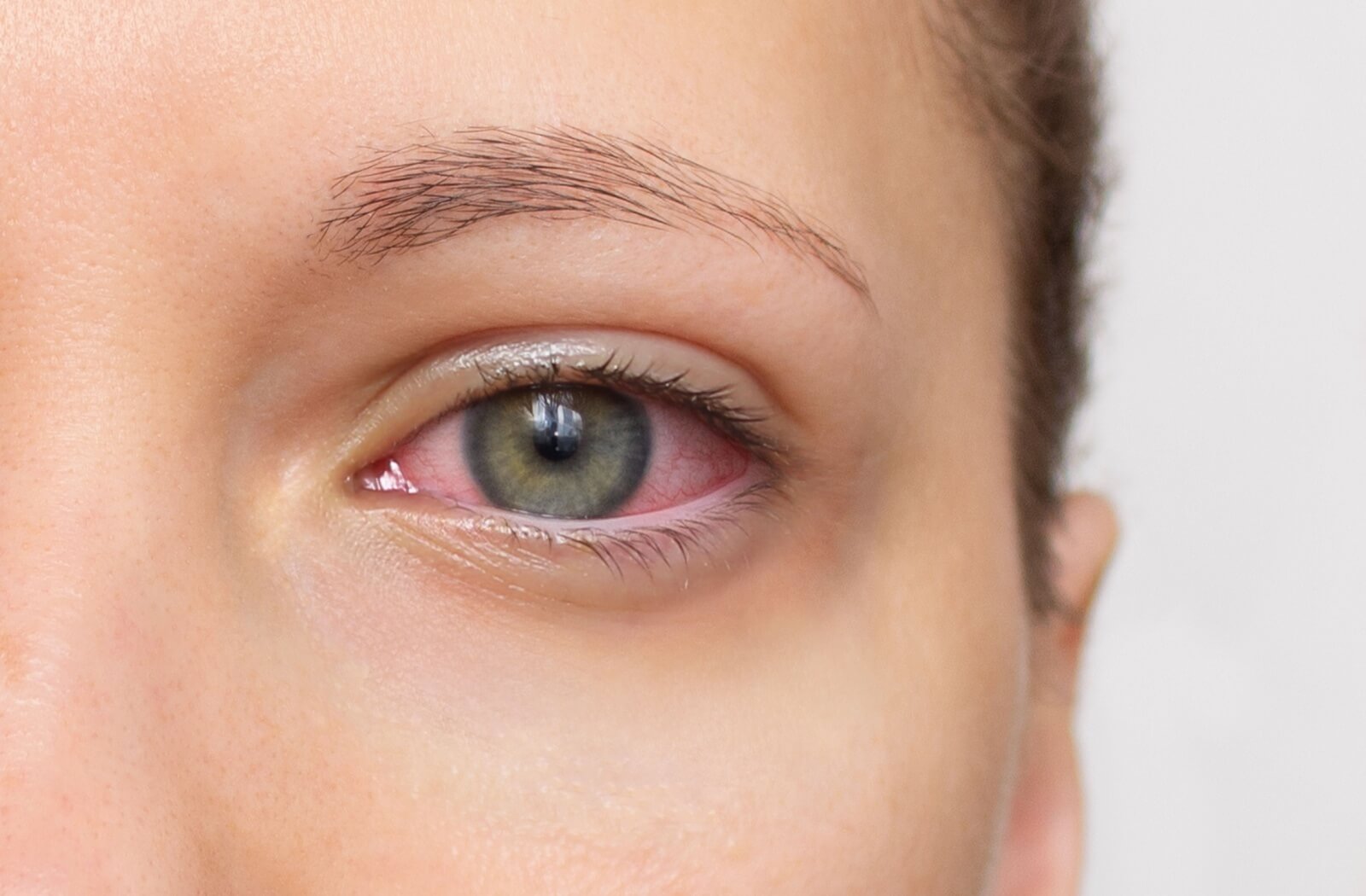 Close-up of an eye with visible redness and irritation along the lower eyelid, showing signs of discomfort or inflammation.